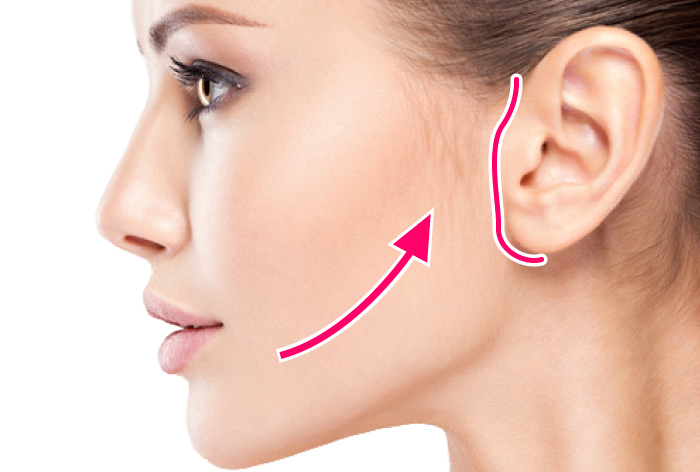 フェイスリフト