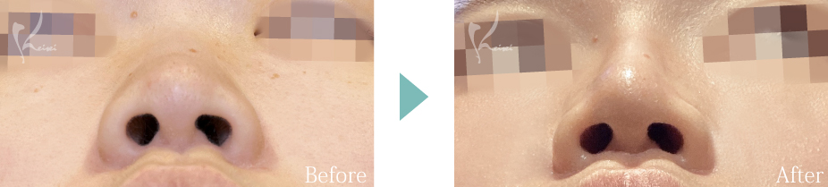 鼻尖形成＋隆鼻術（プロテーゼ）の症例写真