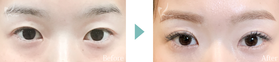 全切開法の症例写真