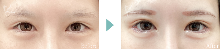 下眼瞼下制術（垂れ目形成術）の写真