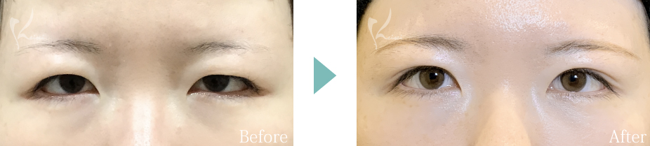 眼瞼下垂の症例写真