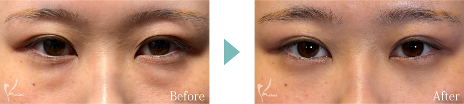 目の下の脱脂法の症例写真