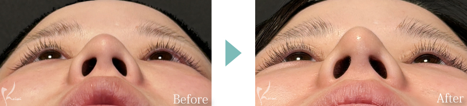 鼻尖形成＋耳介軟骨移植 症例写真