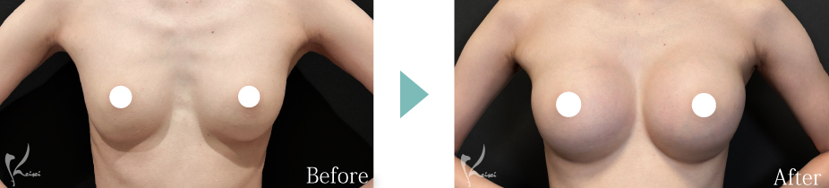 シリコンバッグ豊胸症例