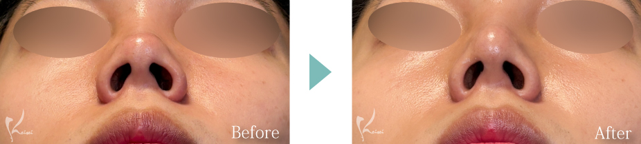 鼻尖形成＋隆鼻術（プロテーゼ）＋鼻中隔延長（耳介軟骨移植）