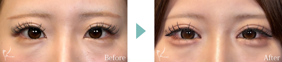 目頭切開の症例写真