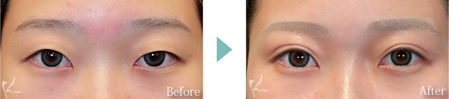 MT埋没法＋二重脱脂法　症例写真