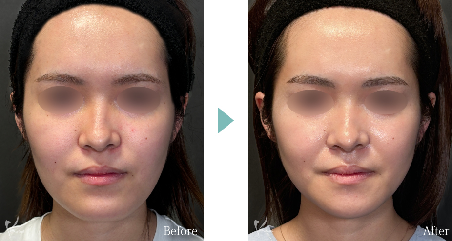 Vライン形成（エラ+顎）：エラの骨切り（下顎角形成）とアゴ（オトガイ形成）症例写真