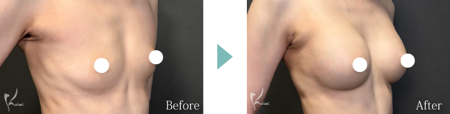 シリコンバッグ豊胸症例