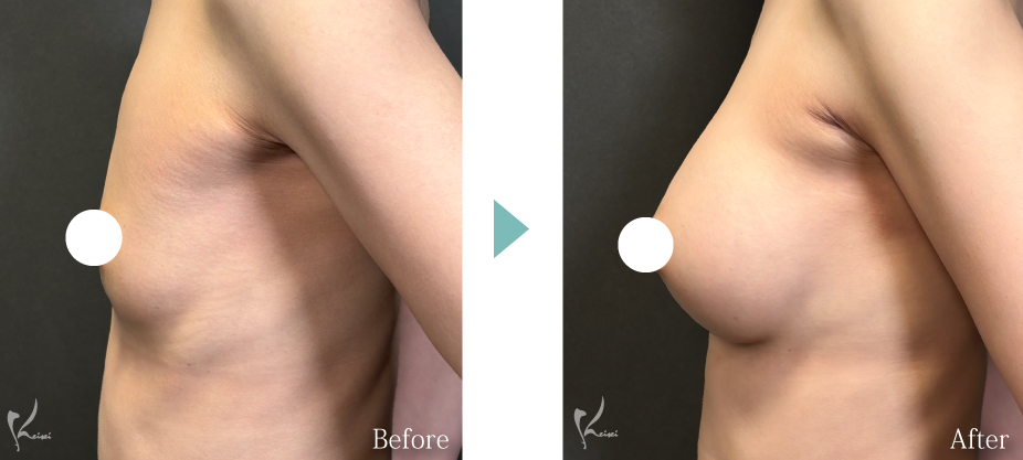 シリコンバッグ豊胸症例