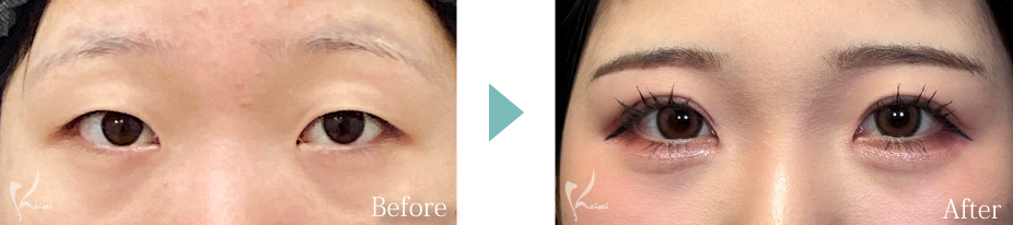 MT埋没法の写真