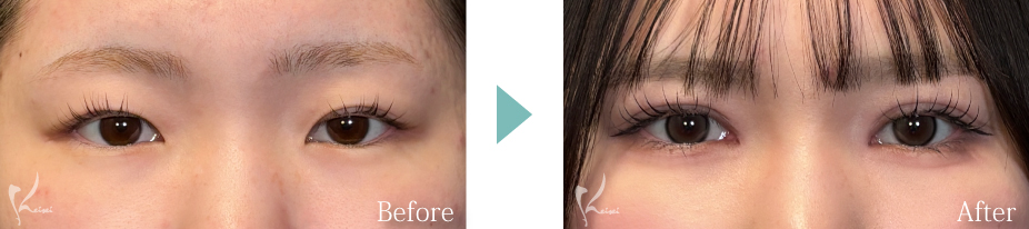 MT埋没法：3点留め＋目頭切開の写真