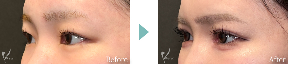 MT埋没法：3点留め＋目頭切開の写真