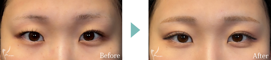 MT埋没法の写真