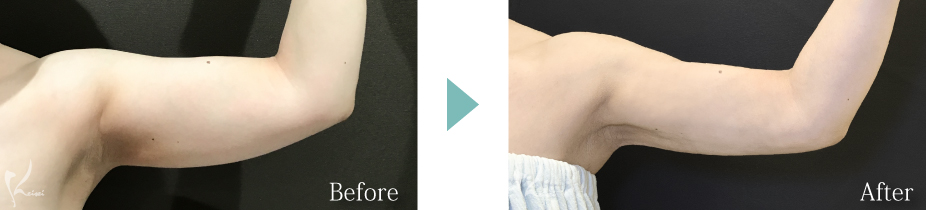 上腕のボディジェット脂肪吸引の症例写真