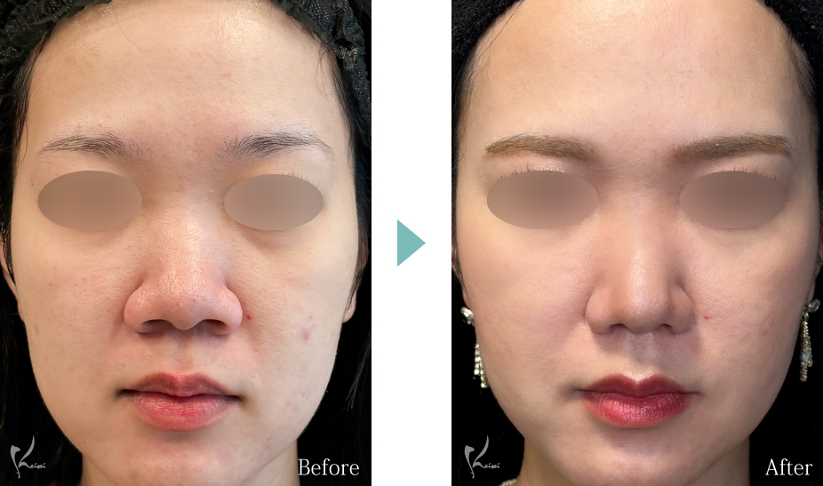 小鼻縮小（鼻翼縮小）＋鼻尖形成＋鼻中隔延長（耳介軟骨移植）の症例写真