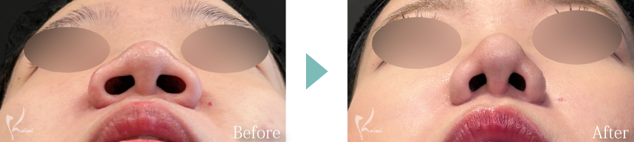 小鼻縮小（鼻翼縮小）＋鼻尖形成＋鼻中隔延長（耳介軟骨移植）の症例写真