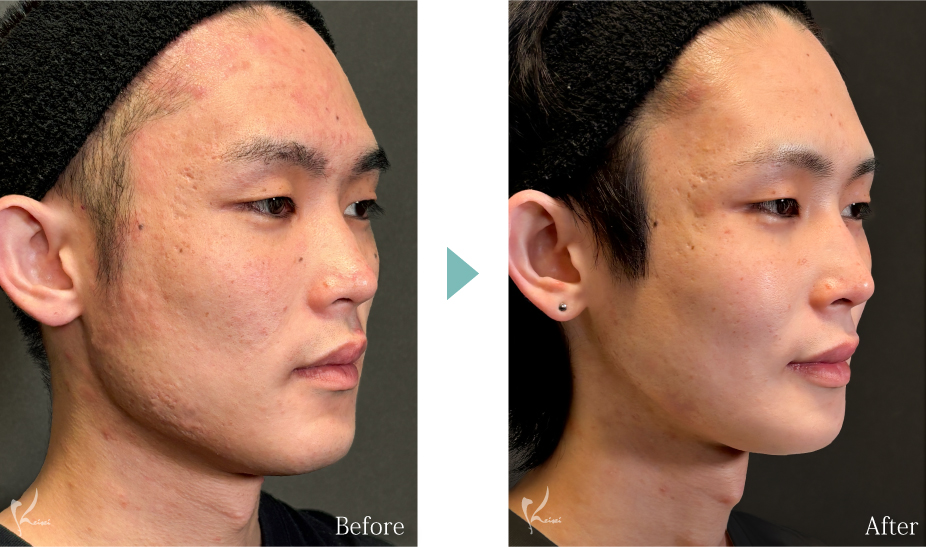 輪郭3点（頬・エラ・オトガイ骨切り）の症例写真