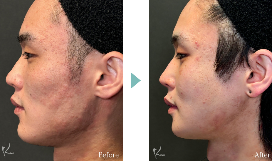 輪郭3点（頬・エラ・オトガイ骨切り）の症例写真