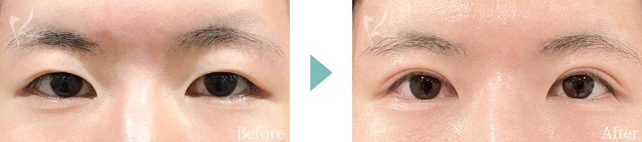 全切開法の症例写真