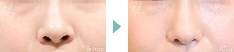 小鼻縮小（鼻翼縮小）の症例写真