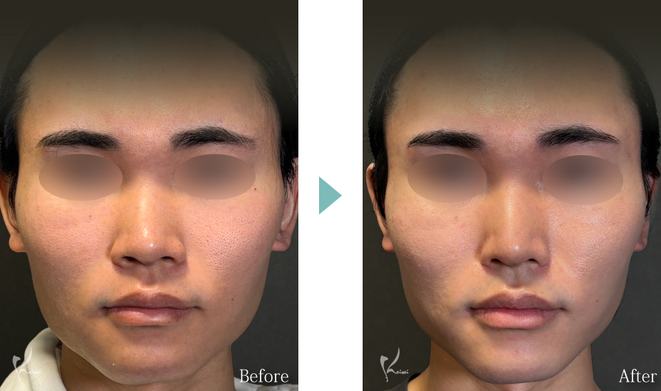 鼻尖形成＋小鼻縮小（鼻翼縮小）＋鼻中隔延長の症例写真