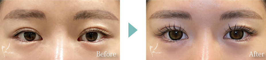 下眼瞼下制術（垂れ目形成術）の写真