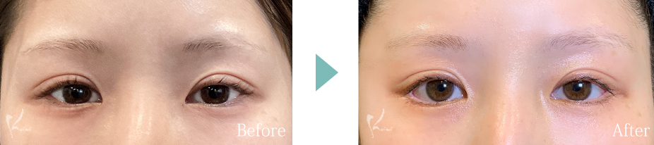 下眼瞼下制術（垂れ目形成術）の写真