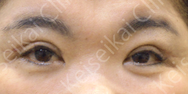 眠たそうなまぶたをスッキリ！眼瞼下垂手術