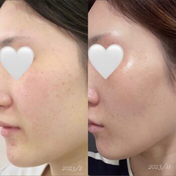 フォトフェイシャル　ビフォーアフター