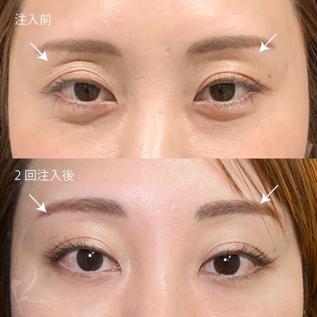 PRP療法（自己多血小板血漿注入療法）