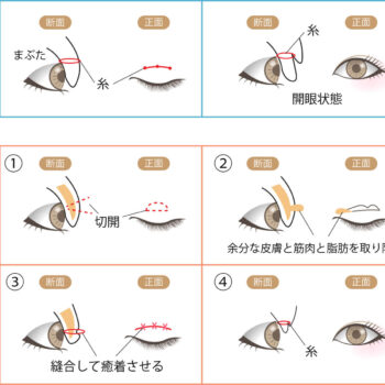 埋没法と全切開 なにが違う？