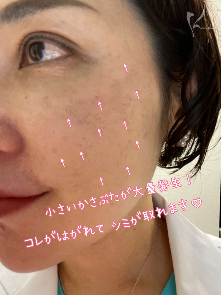 フォトフェイシャル後シミが浮いている様子