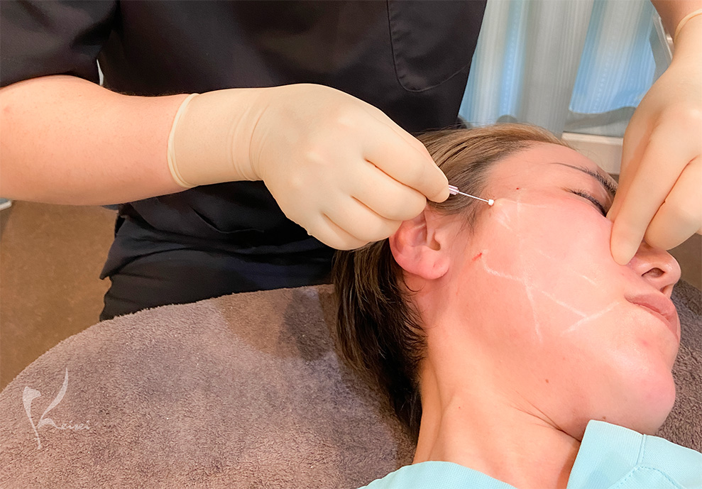 糸リフトを受けている小西医師