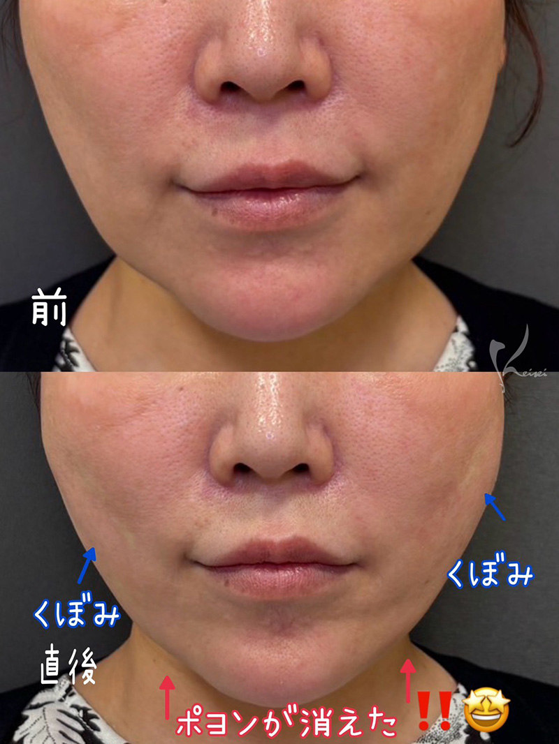 小西医師糸リフトのビフォーアフター