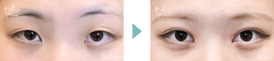 目頭切開＋MT埋没法の症例写真