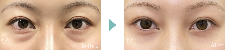 目の下の脱脂法の症例写真