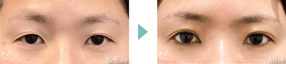 全切開法の症例写真