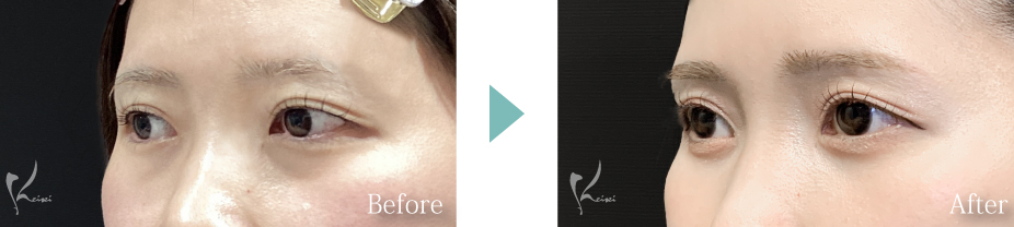 目の下の脱脂法の症例写真