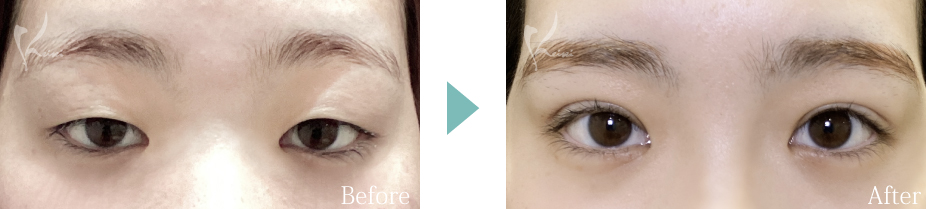 眼瞼下垂の症例写真