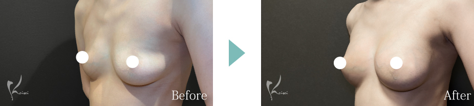 シリコンバッグ豊胸症例