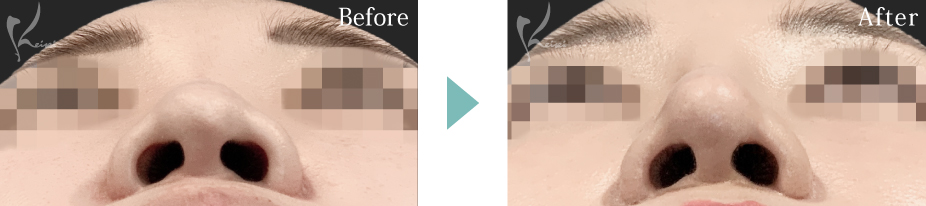 鼻尖形成＋隆鼻術（プロテーゼ）＋小鼻縮小（中間法）＋鼻中隔延長（耳介軟骨移植）の症例写真