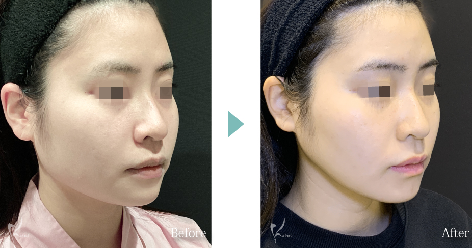 エラ骨切り（下顎角形成）症例