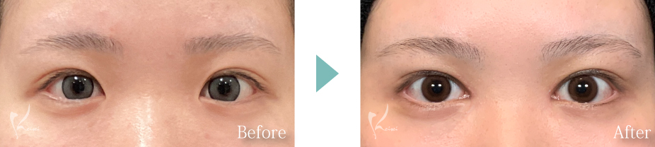 目頭切開の症例写真