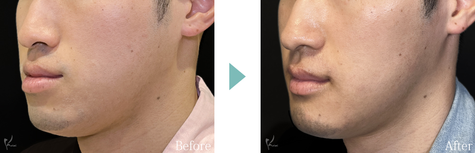 下顎セットバックの症例