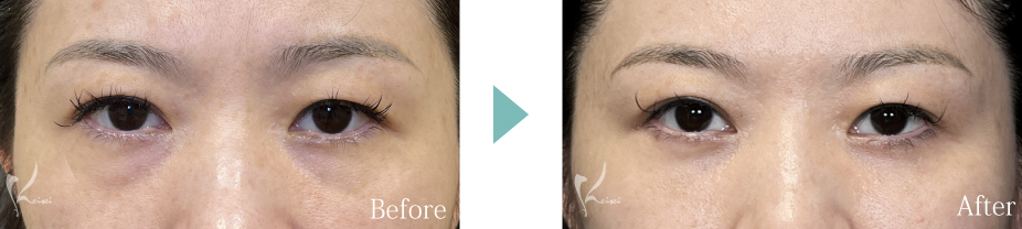 目の下の脱脂法の症例写真