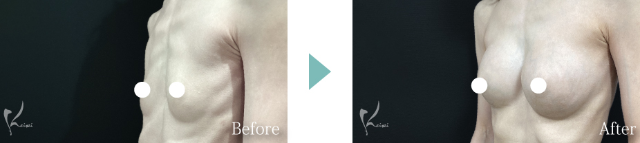 シリコンバッグ豊胸症例