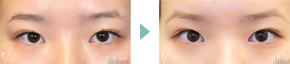 下眼瞼下制術（垂れ目形成術）の写真