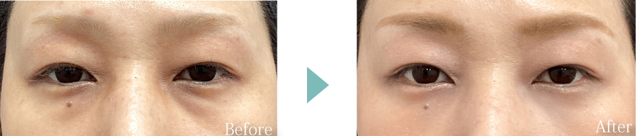 目の下の脱脂法の症例写真