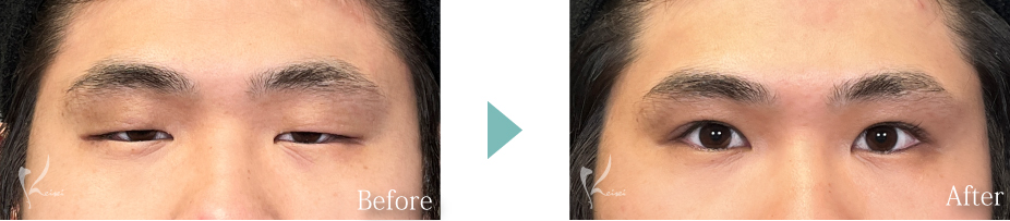 眼瞼下垂の症例写真